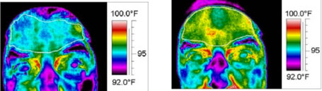 Therapieerfolg Biofeedback HEG