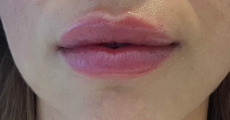 Lippen unterspritzen