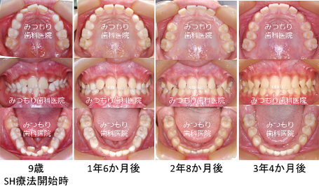 矯正の症例