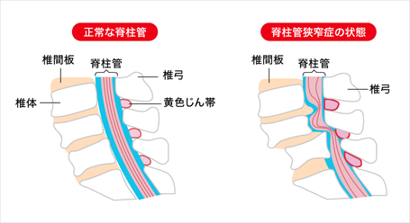 筋膜性疼痛　トリガーポイント　鍼　鍼灸　筋膜　痛み　松戸　脊柱管狭窄