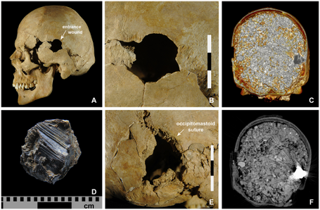 Individu blessé à la tête par un projectile en plomb d'un mousquet, qui a finit sa course de l'autre côté du crâne. Crédit : K. Bentele, N. Nicklisch, S. Brandt