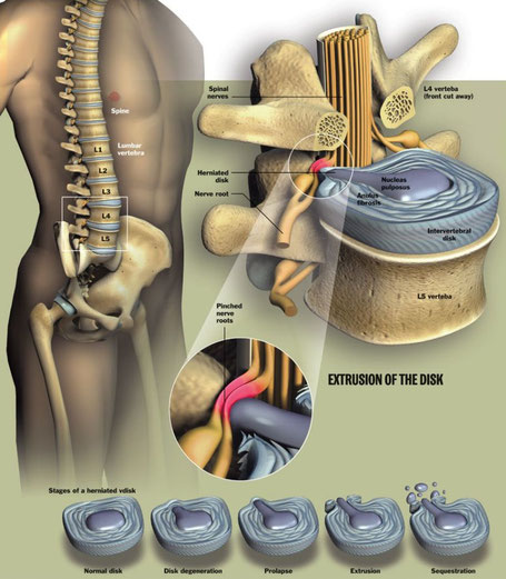 Detailed picture of a herniated disc