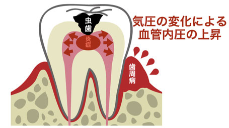気圧の変化による歯の痛み