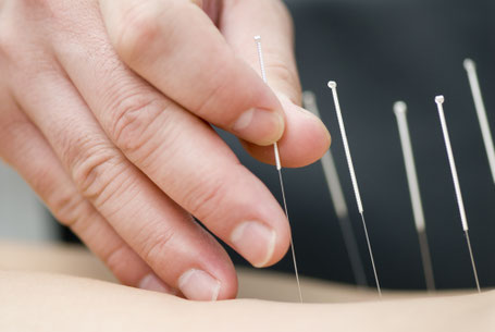 Acupunctuur naalden
