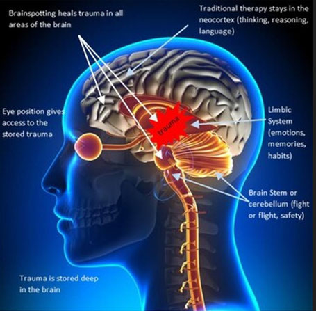 brainspotting EMDR traumatherapie
