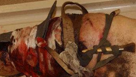 Torniquete real improvisado. Uso inadecuado debido a la banda tan estrecha utilizada