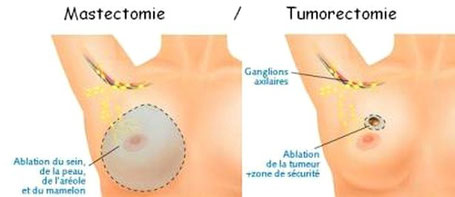 Mastectomie (ablation totale à gauche) et tumorectomie (ablation partielle à droite)