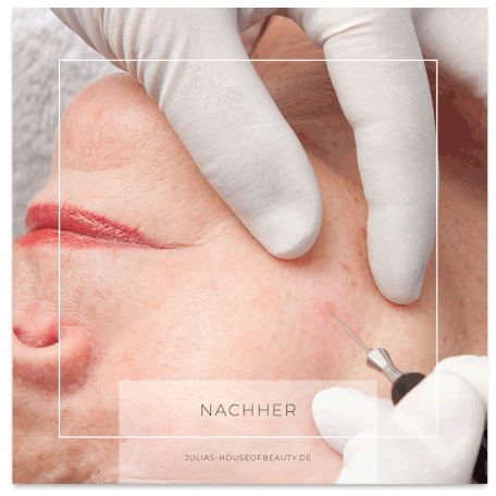 Pigmentflecken mit Radio Wave Spectrum behandeln in Giessen - Julias house of beauty