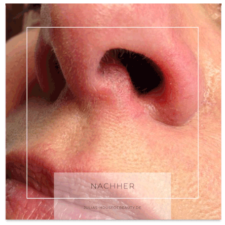 Rote Aederchen entfernt mit Radio Wave Spectrum - Julias house of beauty