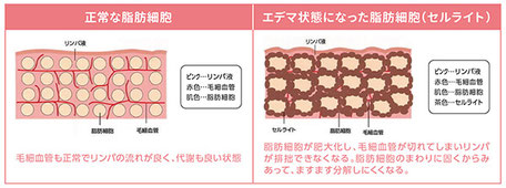 セルライトの仕組み　福岡　エクラプラス