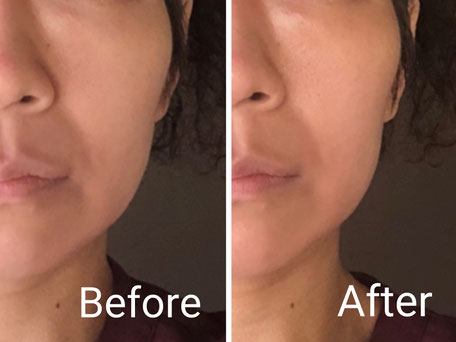 高濃度酸素コスメmirey ミレイ アンカサ 福知山 舞鶴 綾部 肩こり 腰痛 冷え むくみ 骨盤矯正 根本改善 体質改善