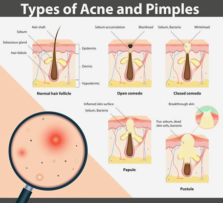 La ghiandola sebacea e le sue alterazioni: brufoli e acne