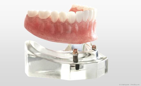 Modell mit Implantaten und Prothese
