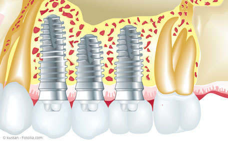 Grafische Darstellung von Implantaten