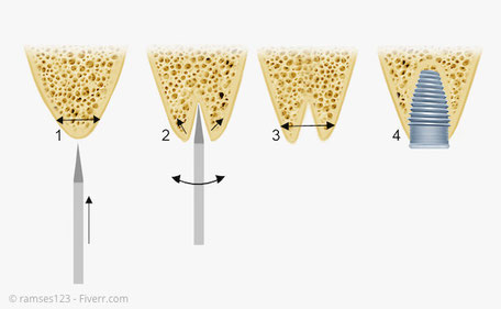 Grafik Knochenspreizung