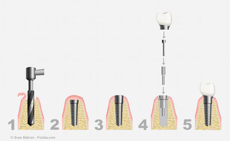 Grafische Darstellung Ablauf Implantation