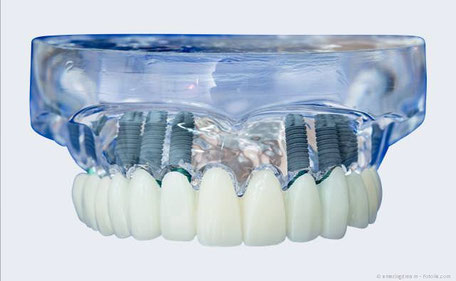 Modell mit Implantaten und festsitzender Brücke