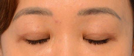 Double eyelid scar cheap