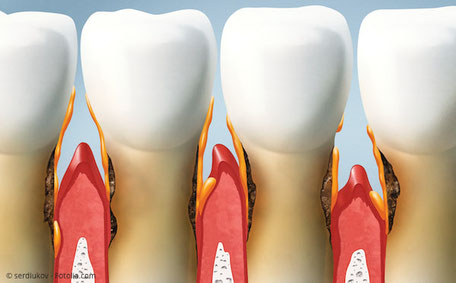 Zahnfleischtaschen und Zahnfleischentzündung bei Parodontitis