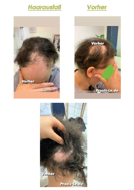 Alopecia behandeln bei Michael Le