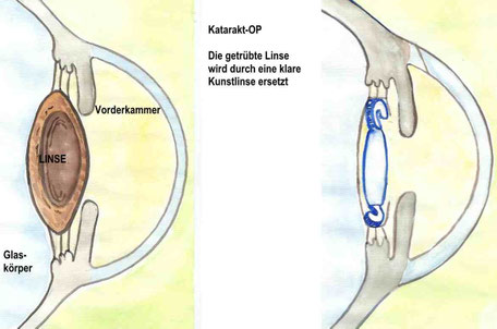 Endgltige Sehschrfe Nach Katarakt Op