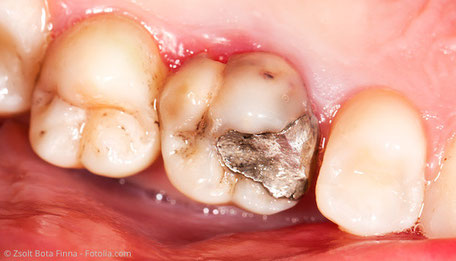 Zahn mit Amalgamfüllung