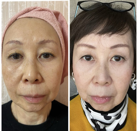 67歳、女性の症例