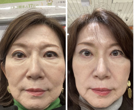 64才、女性の症例