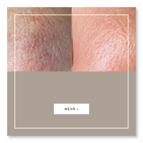 Makellose Haut mit Radio Wave Spectrum - Julias house of beauty in Giessen
