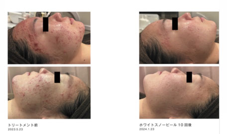 ニキビケアにも対応しています