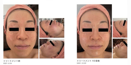 無理なく続けてキレイを取り戻す