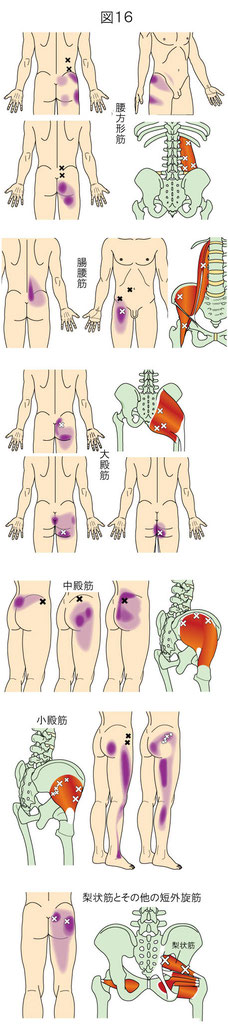 体幹下部の痛みをもたらすトリガーポイント