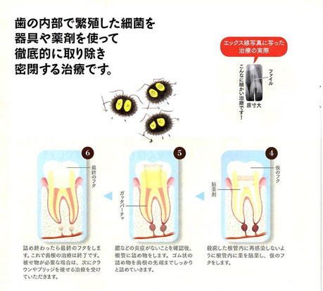 歯の根の治療 永井歯科医院 茨木市 画像２
