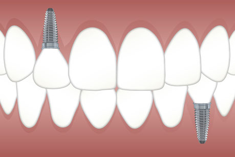 Teeth implants in Kiev