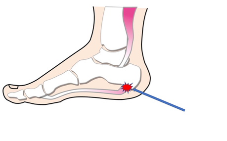 踵の痛み　足裏の痛みには、足底にある筋肉や靭帯にかかるストレスが関係しています。