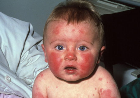 Sindrome congenito de rubeola