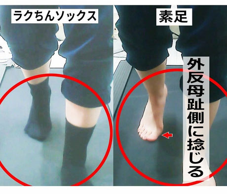 時速４キロ歩行時の歩くと痛む外反母趾の様子
