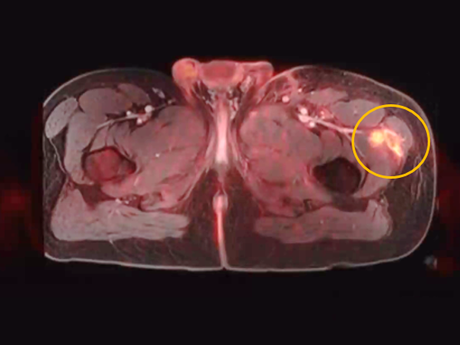 PET-CT scan