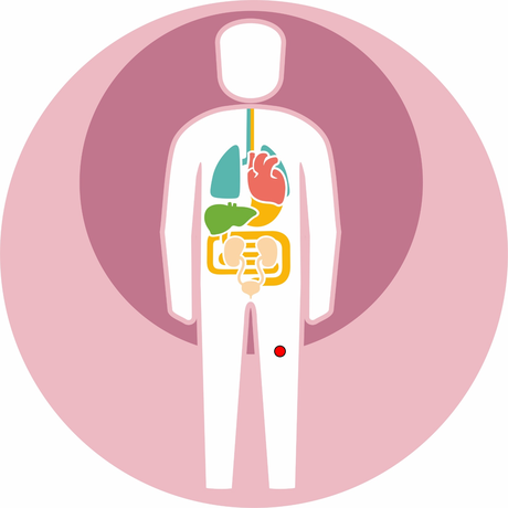 Tumor localisation: femur