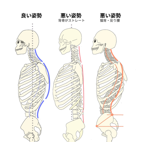 良い姿勢と悪い姿勢（背骨のストレート化、猫背・反り腰）との比較の画像