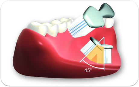 Borsten mit ca. 45 Grad Richtung Zahnfleisch ansetzen. Auf der Stelle rütteln. Dann auswischen. (© proDente e.V.)