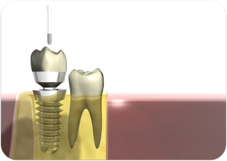 Implantat: Schraubenförmige Wurzel im Kiefer (unten) mit aufgesetzter Krone (oben) (© Markus Kretschmar - Fotolia.com)