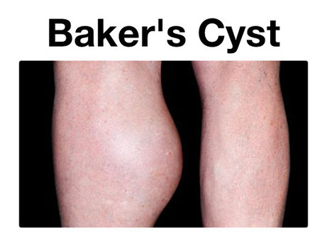 cyst ruptured baker bakers there