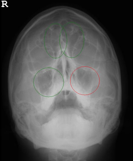 Röntgenbild der Nasennebenhöhlen