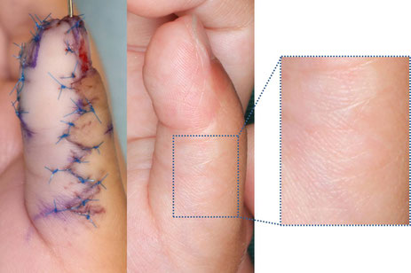 母指多指症のジグザグ型のきずあと