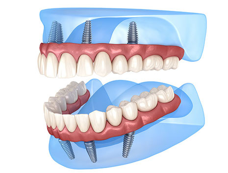 All-on-4 und All-on-6 - feste Zähne an einem Tag | Zahnarztpraxis im Seefeld 