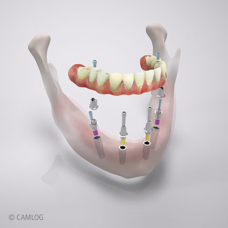 Teleskopversorgung auf 4 Implantaten (all on four)