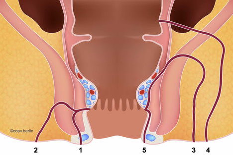 Classification an location of anal fistula - COPV Berlin proctology