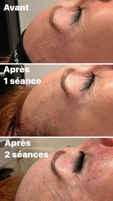 Avant/Après 2 séances HIFU visage: lifting naturel, rides lissées, peau lumineuse, effet tenseur immédiat, résultats visibles et progressif. Réactive la production naturelle du collagène et de l'élastine