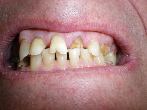 Acid wear or tooth grinding wear can break teeth too